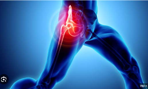 Hip Replacement Surgery: Regaining Your Active Lifestyle