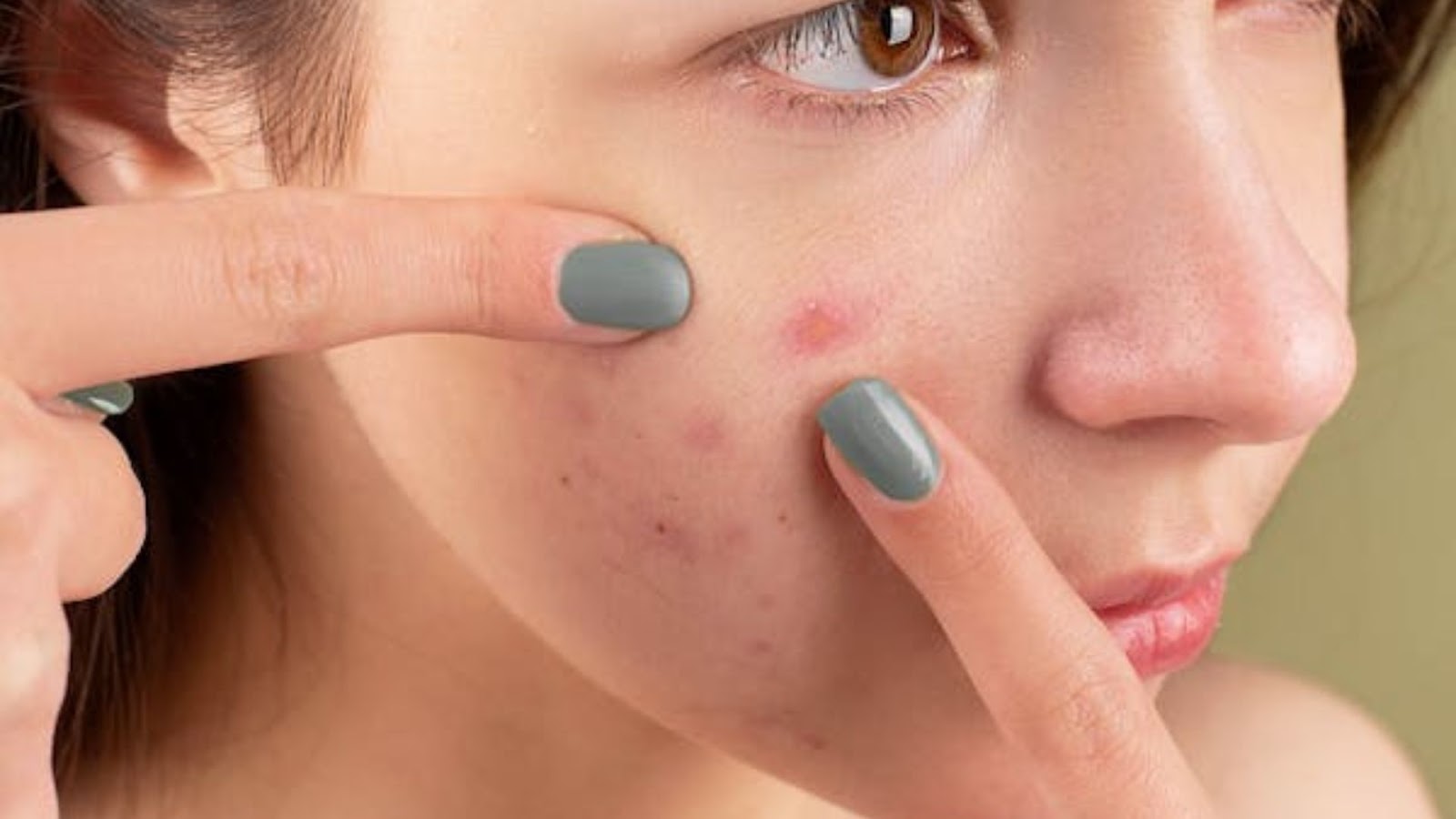 How Ayurveda Provides the Best Pimple Treatment for Lasting Results