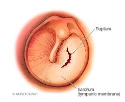 Symptoms of a Ruptured Eardrum